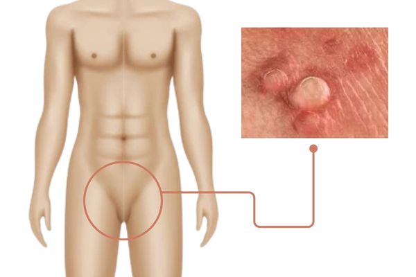 urología condilomas verrugas genitales hombre