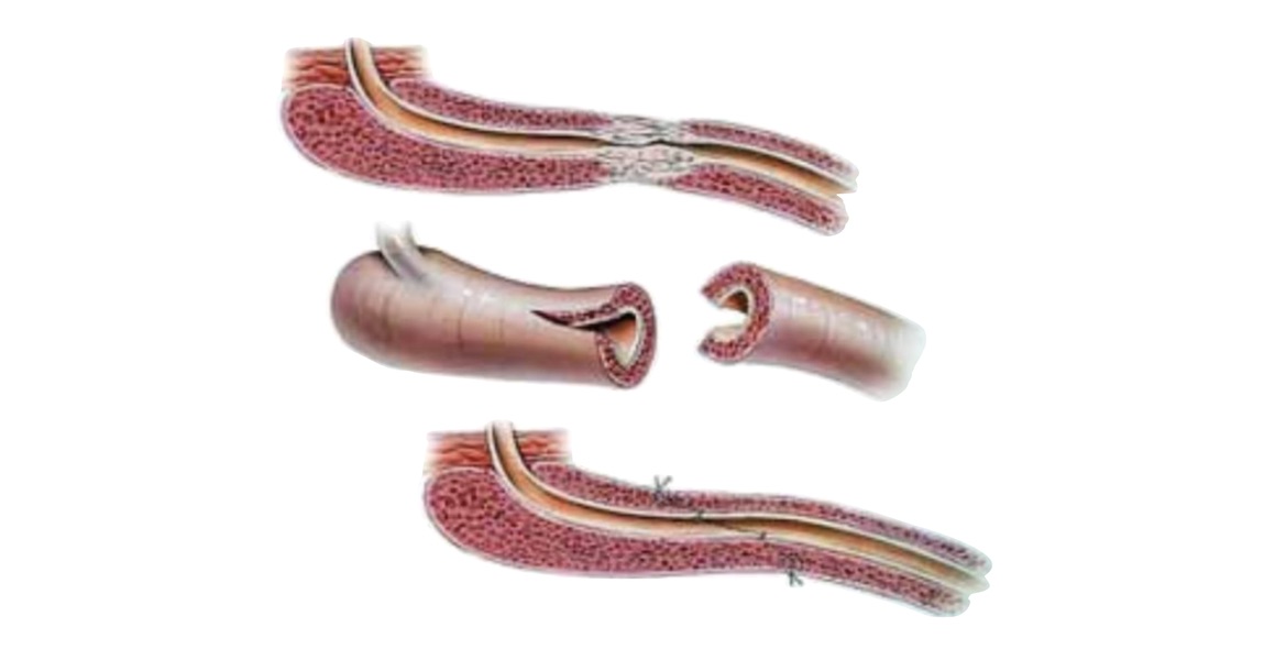 uretroplastía en clínica de santiago