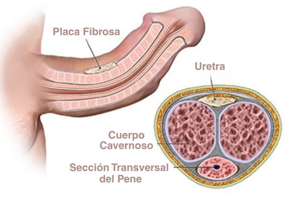solución para pene torcido