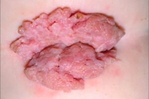 Verrugas Genitales y Tratamiento Médico de Urgencia en santiago