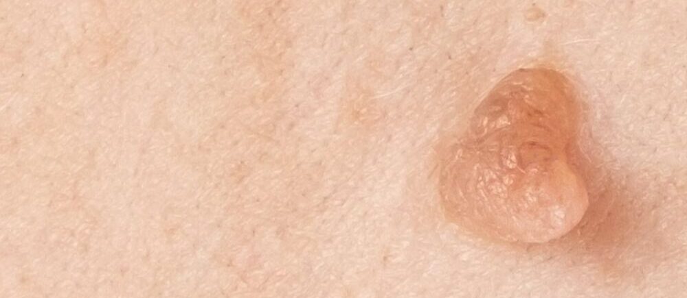 Verrugas genitales, Tratamiento para Verrugas Genitales