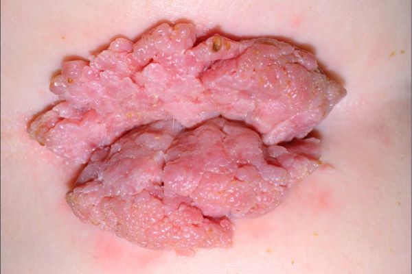 Verrugas Genitales y Tratamiento Médico de Urgencia en santiago