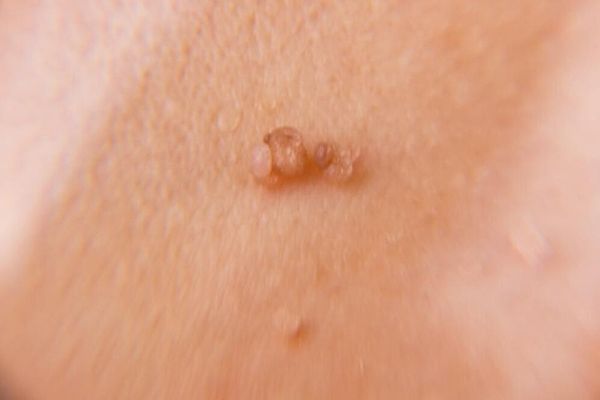 verrugas de vph
