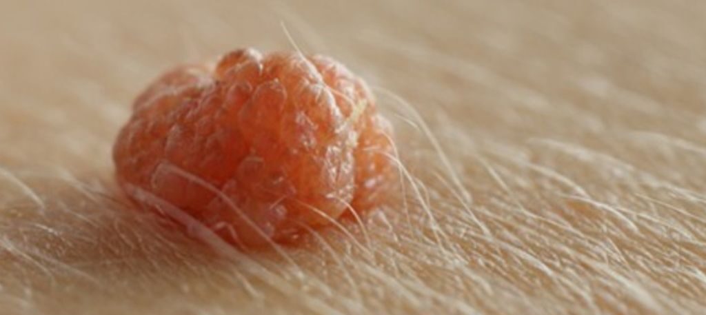 Verrugas genitales y extracción de urgencia