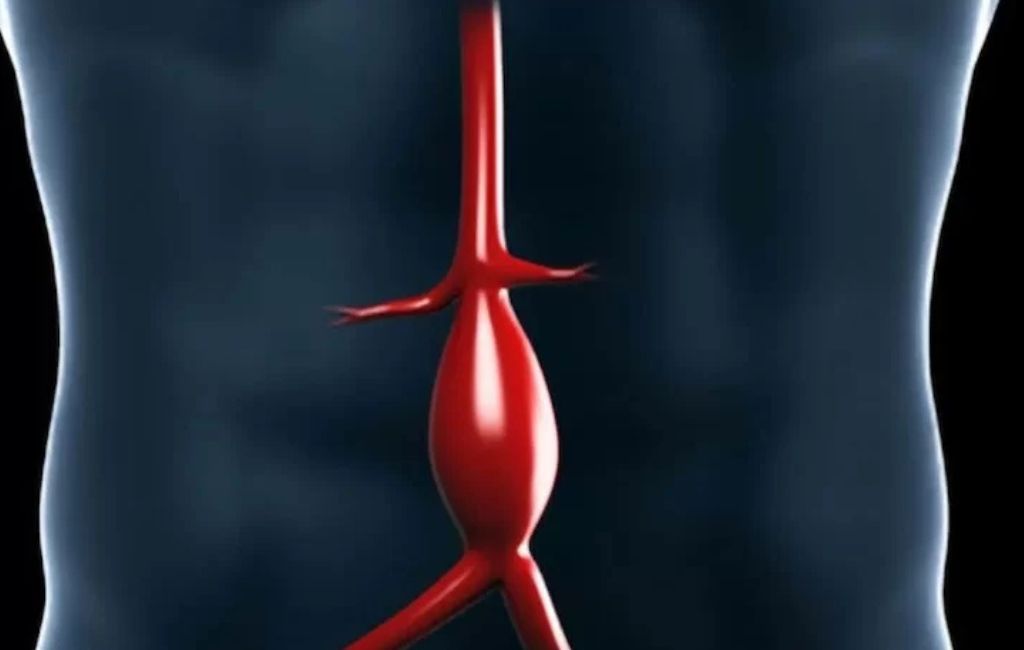 Aneurisma cirujano vascular