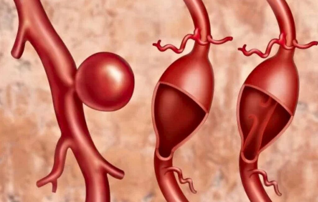 aneurismas periféricos atención de urgencia