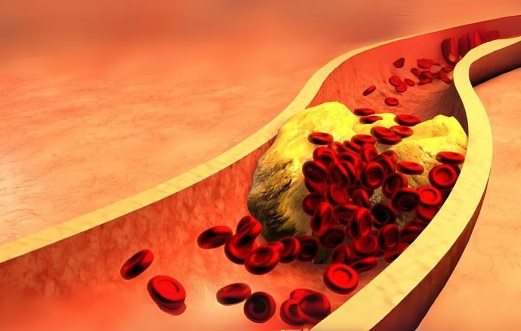 aterosclerosis y cirujano vascular
