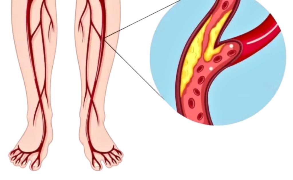 insuficiencia arterial. médico angiólogo