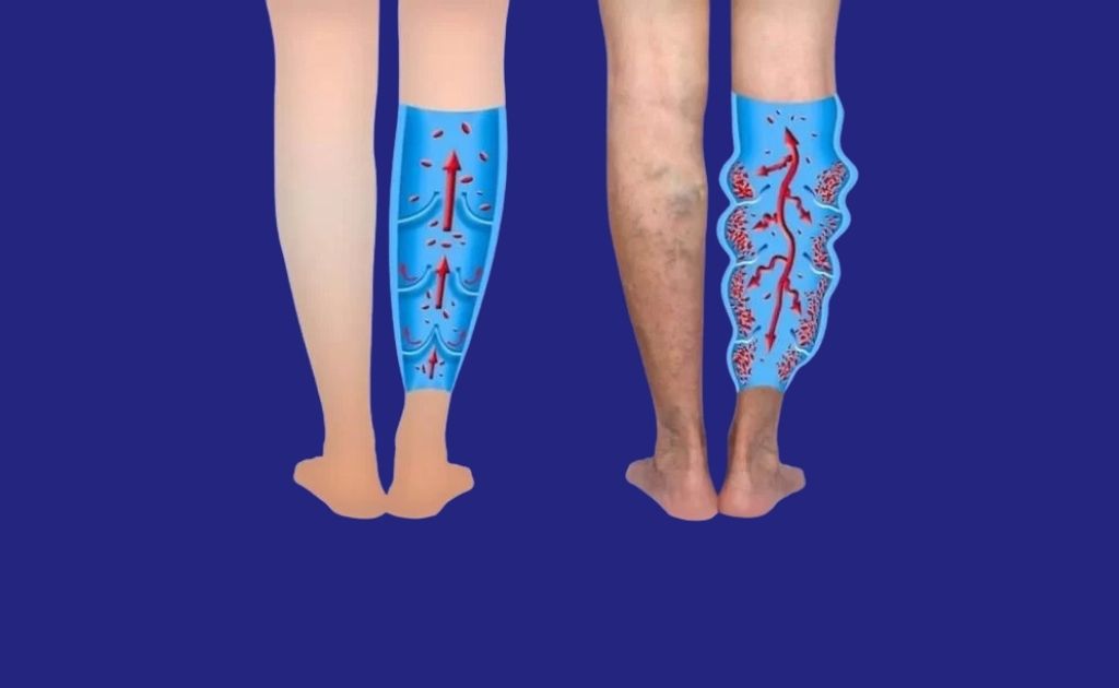 insuficiencia venosa y médico cirujano vascular