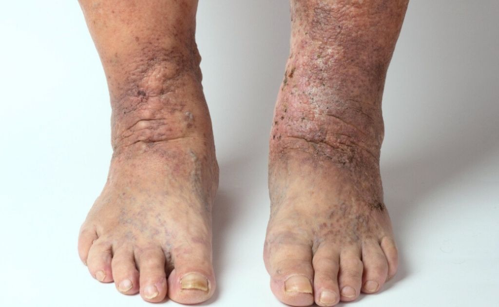 Pié Diabético Mixto médico angiólogo