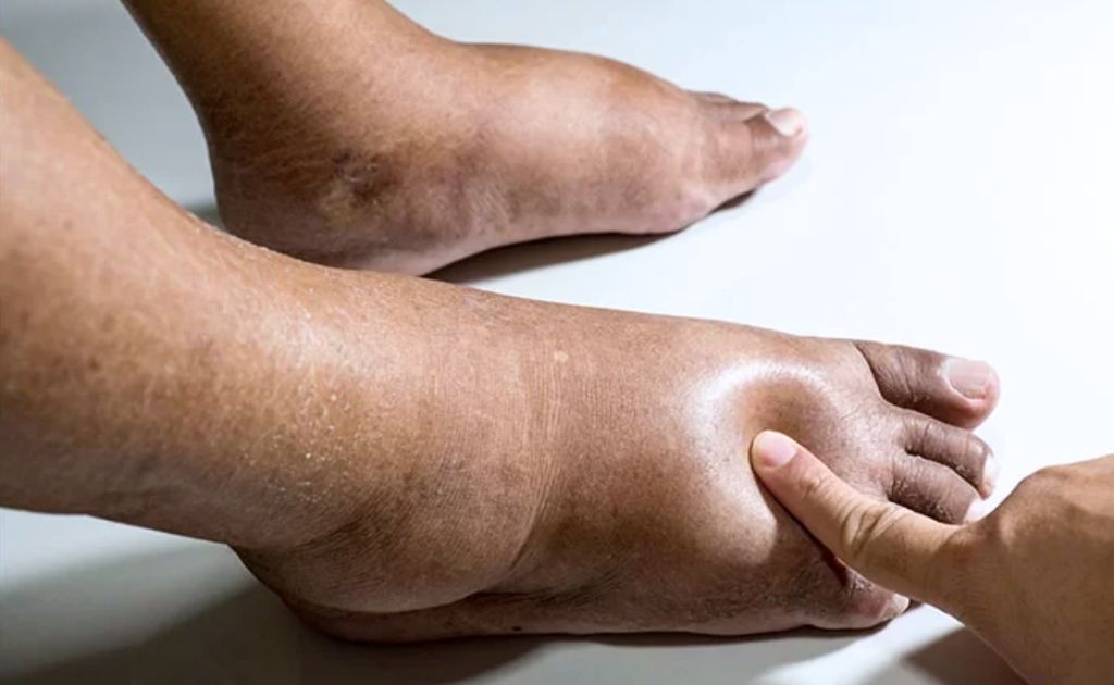 Pié Diabético Neuropático cirujano vascular