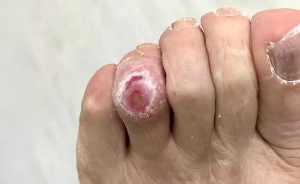 pié diabético cirujano vascular