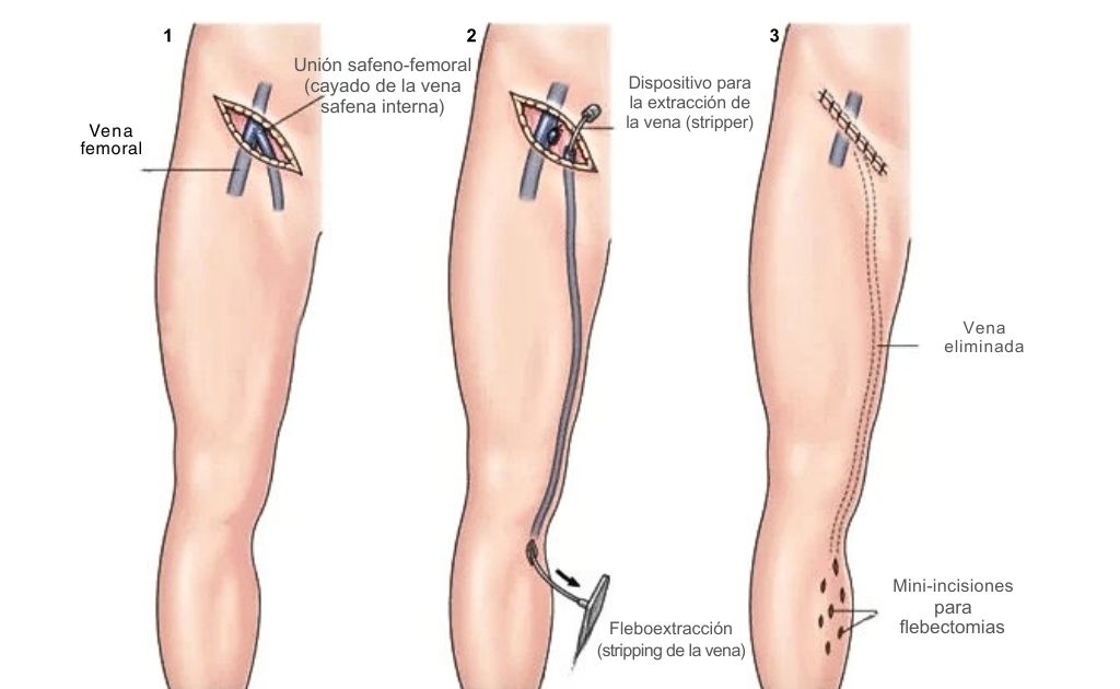 Safenectomía o Stripping cirugía ambulatoria