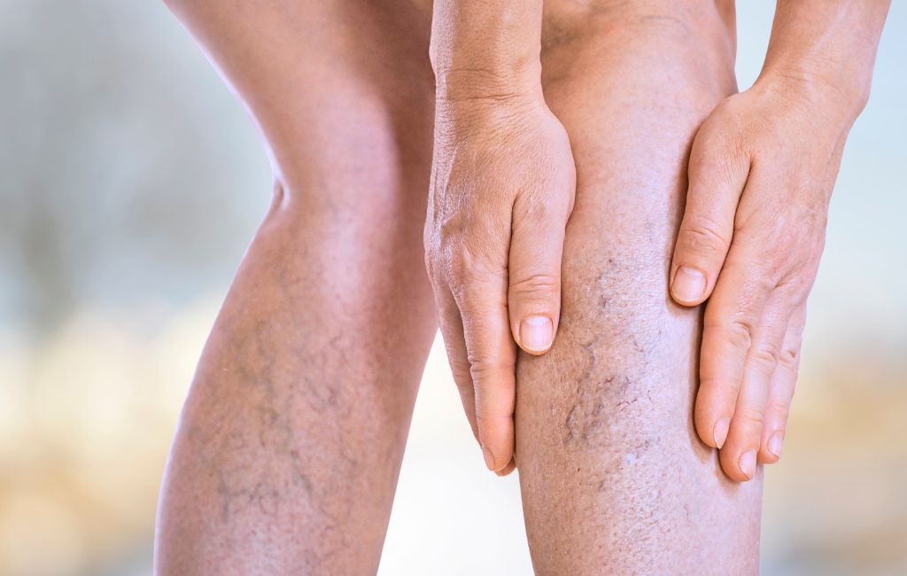 várices y venas tratamiento médico de urgencia