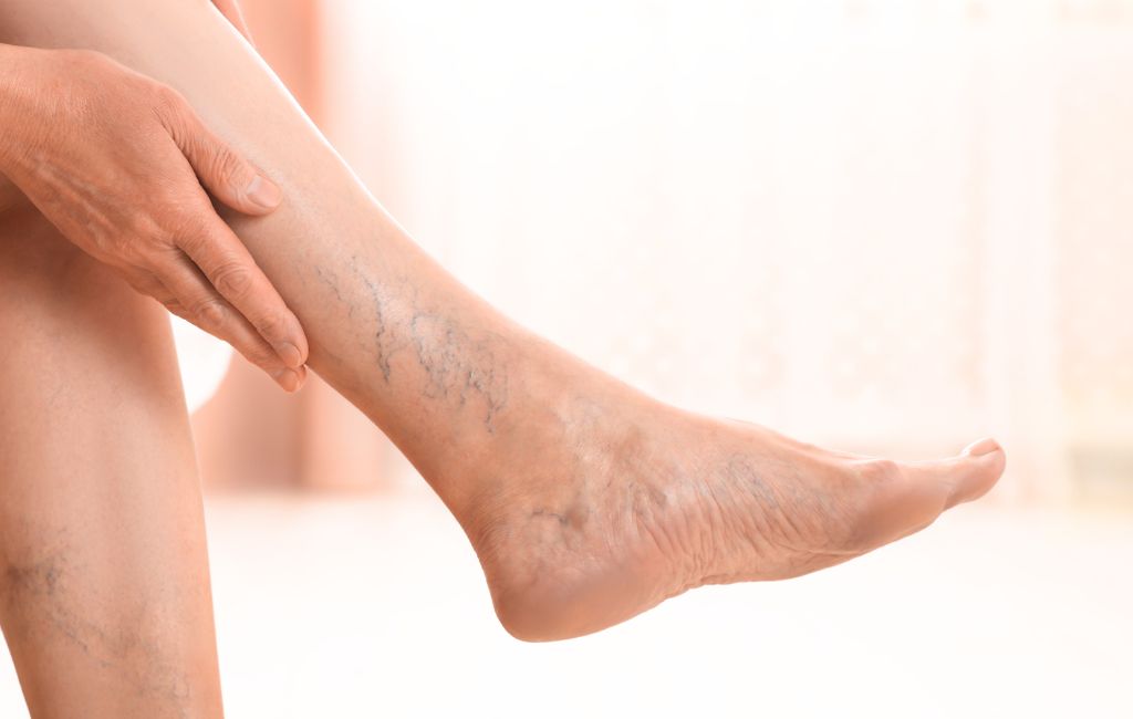 arañas vasculares tratamiento médico