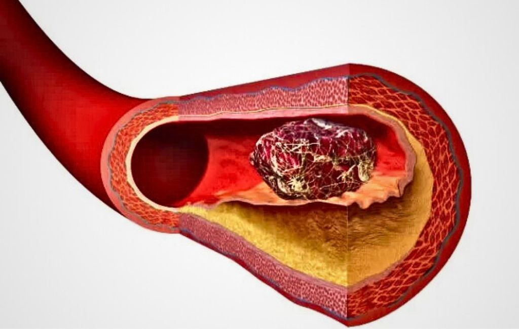 Embolias y atención de urgencia