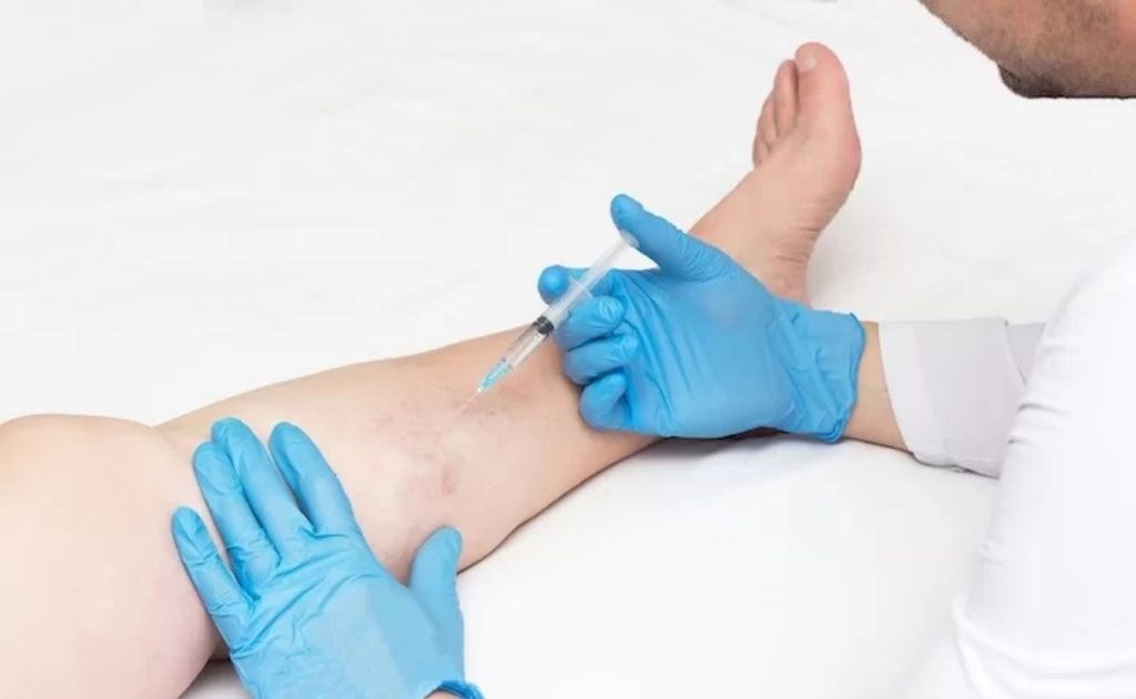 Escleroterapia para várices