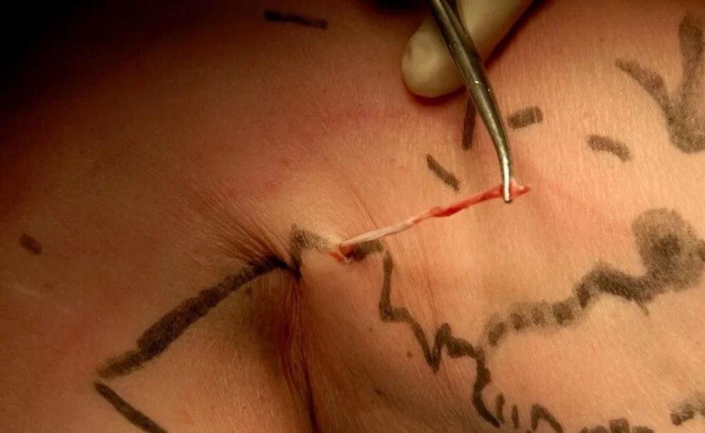 Flebectomía Ambulatoria cirugía en santiago