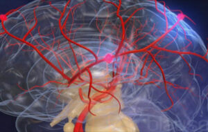 Accidente cerebrovascular (ACV) atención de urgencia en santiago