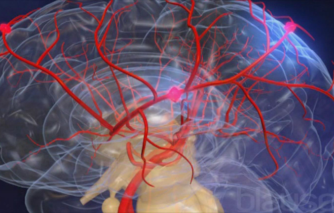 Accidente cerebrovascular (ACV) atención de urgencia en santiago