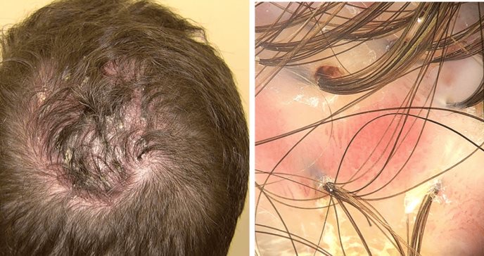 Alopecia Cicatricial tratamiento médico en santiago