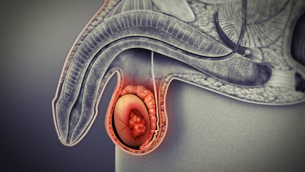 Cáncer Testicular tratamiento de urgencia