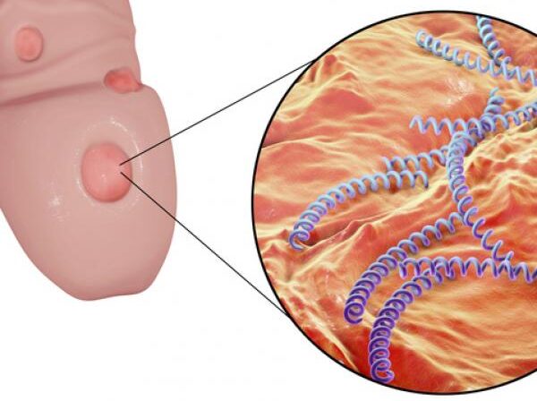 Cáncer de Pene tratamiento de urgencia