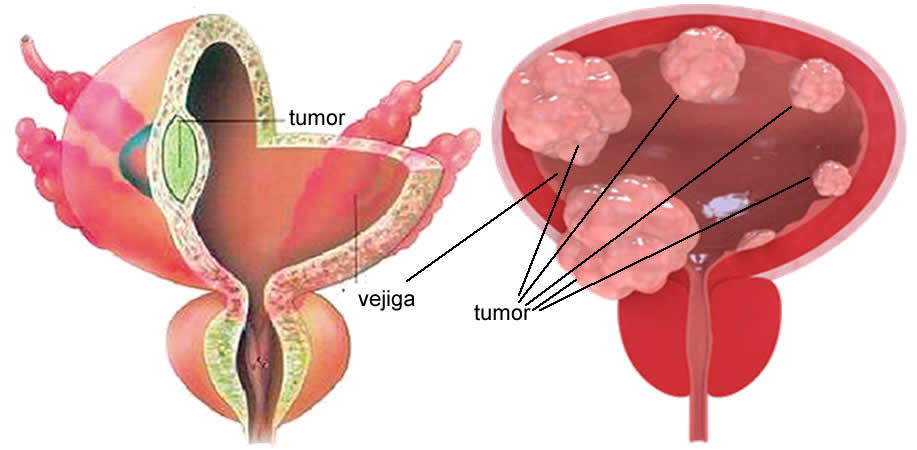 Cáncer de Vejiga médico especialista