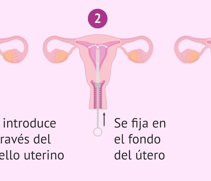 Colocación de DIU de manera ambulatoria