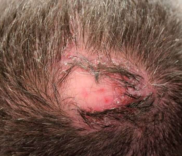 Foliculitis Decalvante atención médica en santiago