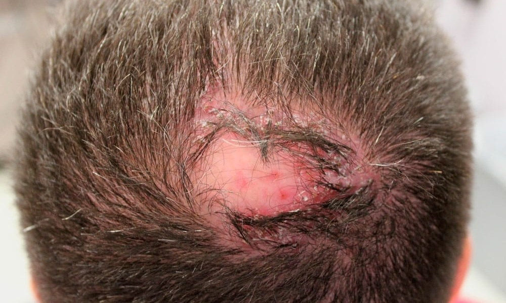 Foliculitis Decalvante atención médica en santiago