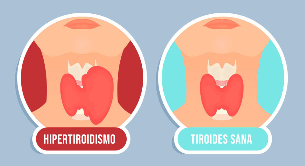 Hipertiroidismo atención médica de urgencia