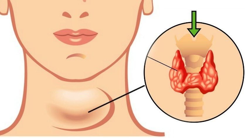 Hipotiroidismo médico en santiago