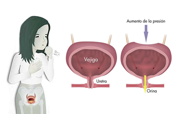 Incontinencia de Esfuerzo diagnóstico y tratamiento