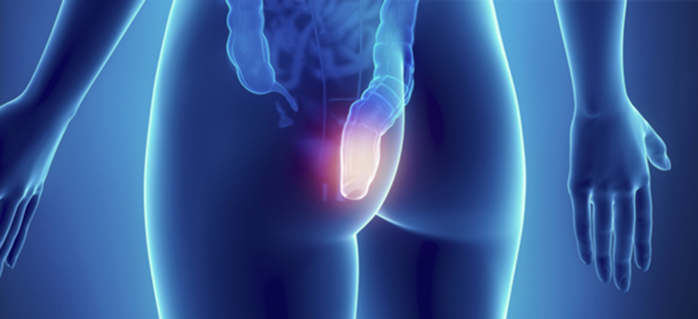 Isquemia Rectal y atención médica de urgencia