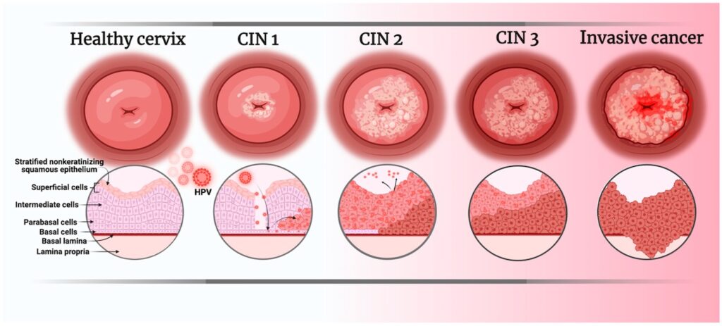 Lesiones Precancerosas Cervicales cirugía de urgencia