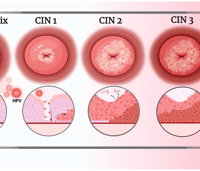 Lesiones Precancerosas Cervicales cirugía de urgencia