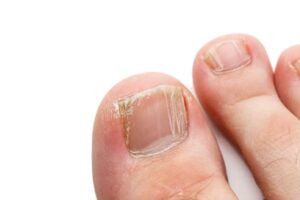 Onicomicosis tratamiento láser