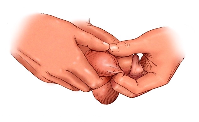 Pelotitas en Testículos o Pene atención de urgencia