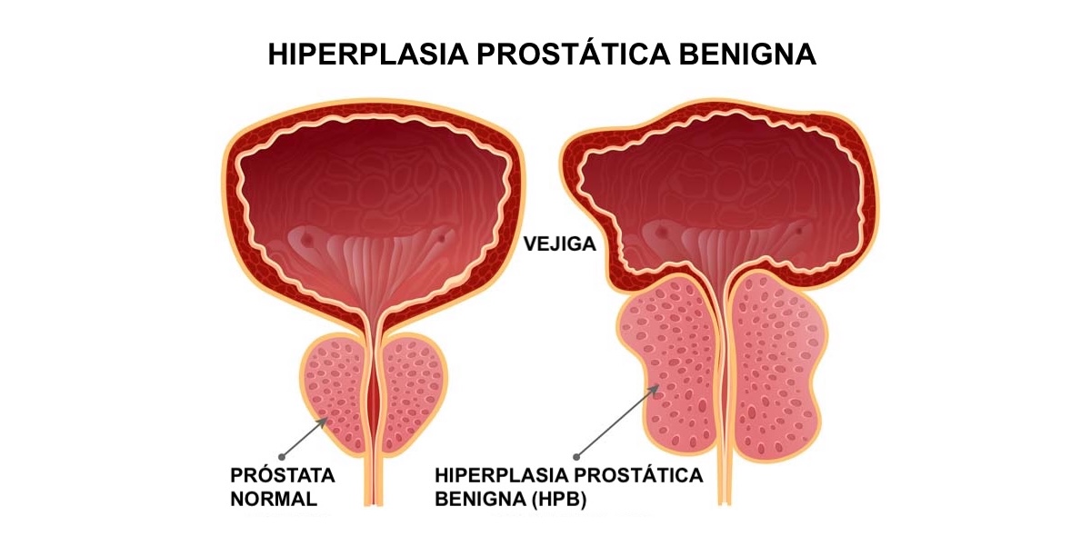 Próstata Agrandada HPB médico urólogo en santiago