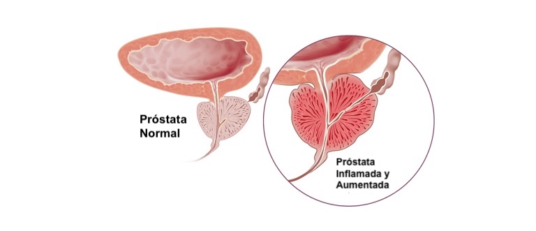 Prostatitis médico de urgencia