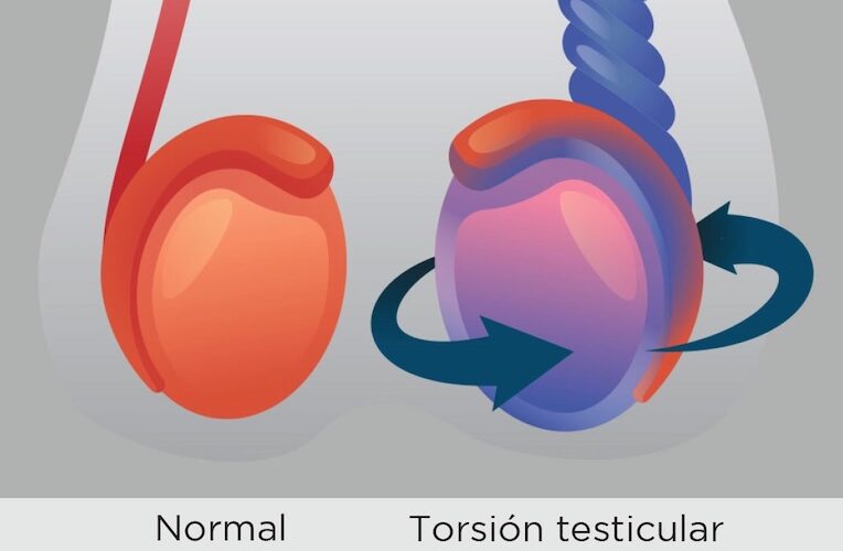 Torsión Testicular cirugía de urgencia
