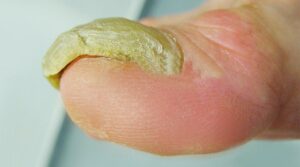 Uña Engrosada médicos especialistas