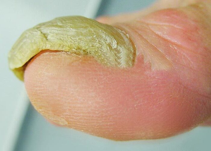 Uña Engrosada médicos especialistas