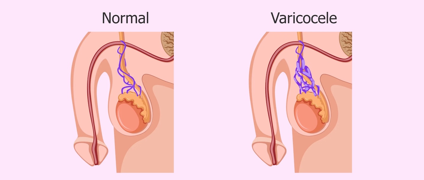 Várices testiculares médicos especialistas