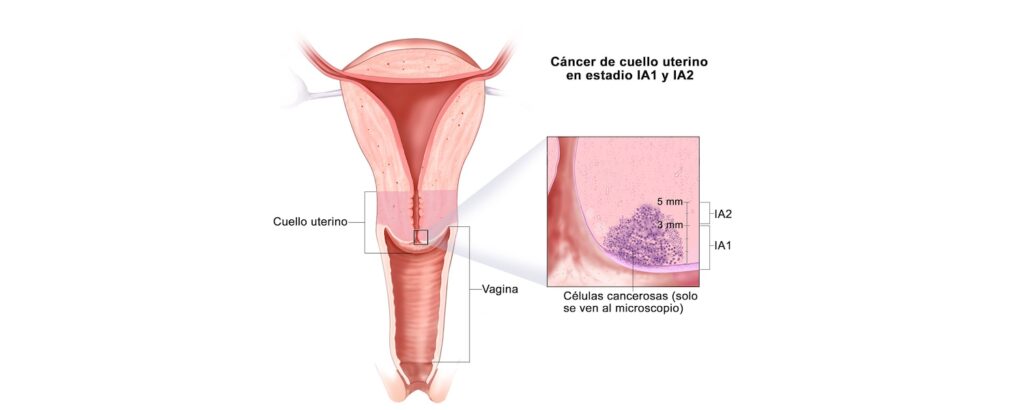 cáncer cervicouterino cirugía cónica