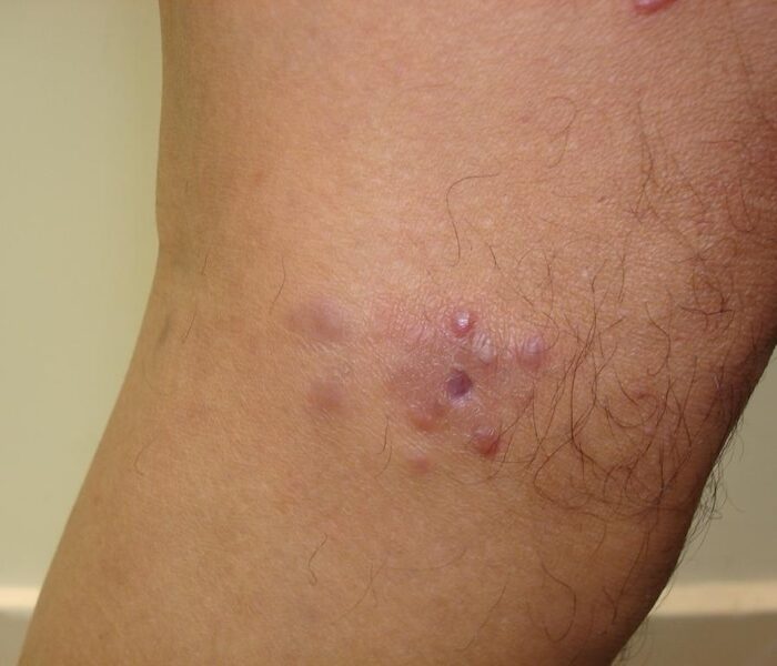 papulosis linfomatoide tratamiento dermatológico