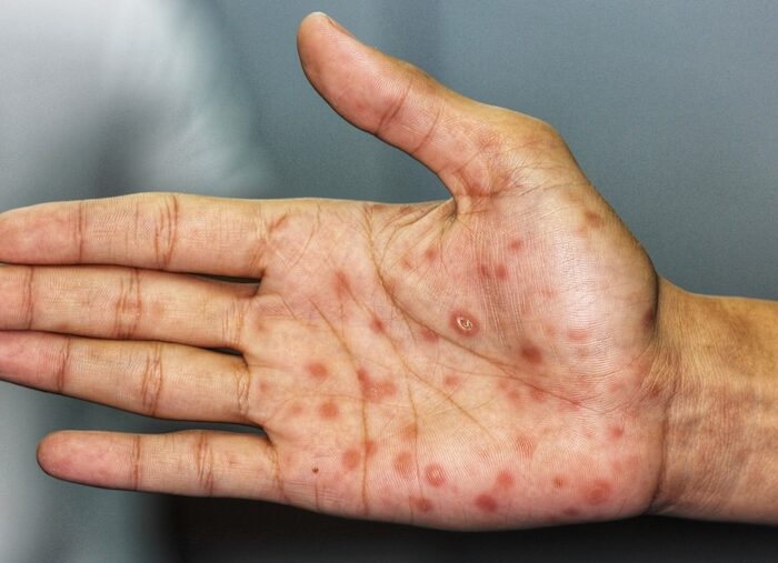 sífilis atención de urgencia