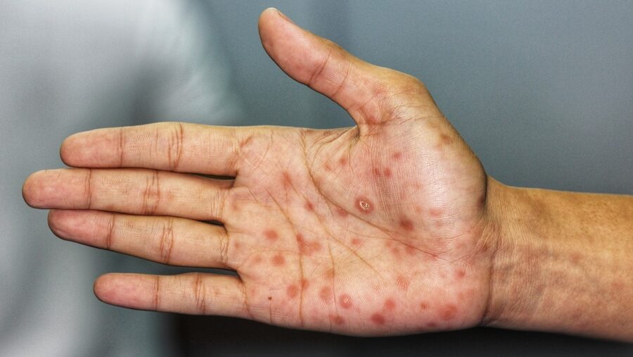 sífilis atención de urgencia