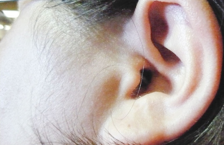 Absceso y/o hematomas oído externo atención de urgencia